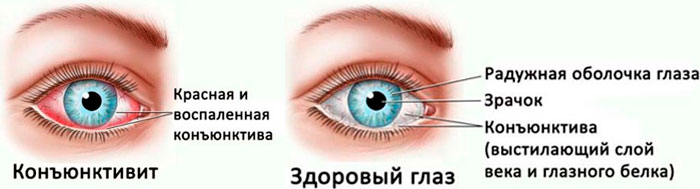 Сравнение глаза при конъюнктивите и здорового глаза