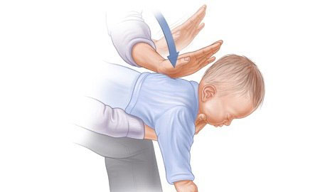 Первая помощь ребенку при проникновении в дыхательные пути инородного тела