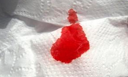 Кровь при трещине ануса