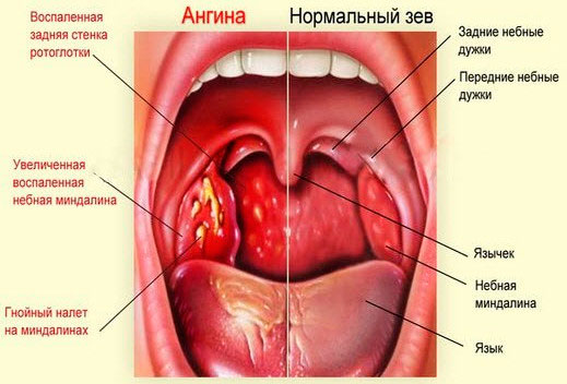 Состояние зева при ангине и при отсутствии болезни