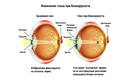 Изменение глаза при близорукости