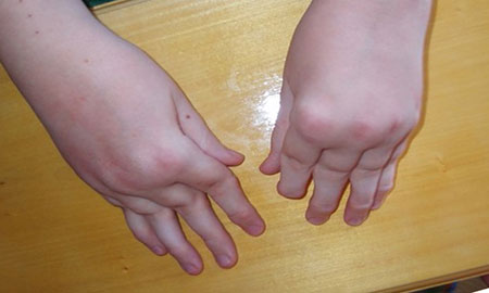 Руки ребенка при артрите