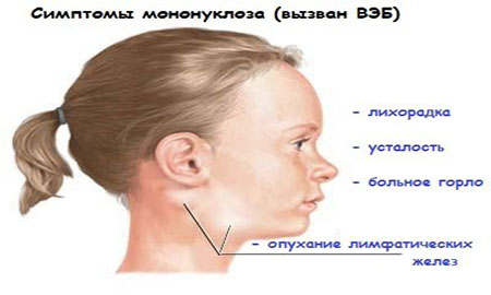 Симптомы мононуклеоза