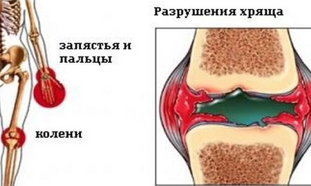  Ювенильный ревматоидный артрит 