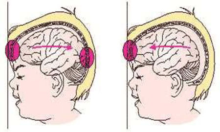 Состояние головного мозга при травме
