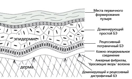 Структура кожи при буллезном эпидермолизе 