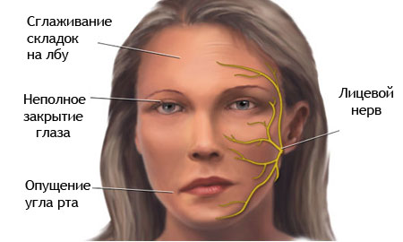  Неврит лицевого нерва 