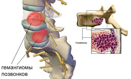 Образование гемангиомы на костях 