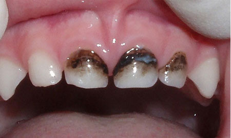  Серебрение молочных зубов 