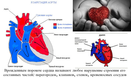 Порок сердца- причина снижения активности малыша 