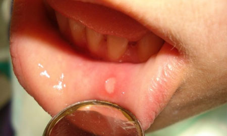 Болячки на внутренней стороне губы