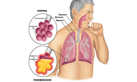 Атипичная пневмония