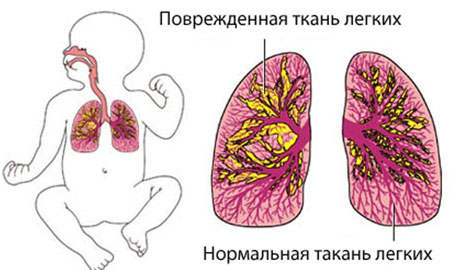  Пневмония у грудничка 