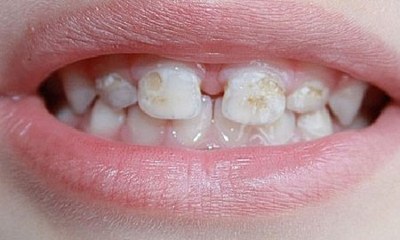  Гипоплазия эмали молочных зубов 