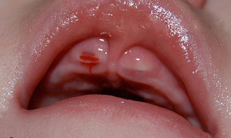 Симптомы прорезывания зубов