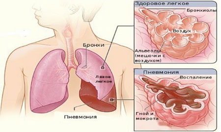 При розеоле возможны осложнения в виде пневмонии 