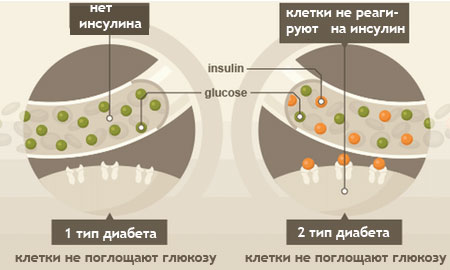 Два вида сахарного диабета 