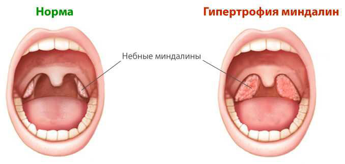 Гипертрофия миндалин