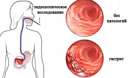 Инфекции желудочно кишечного тракта у детей thumbnail