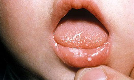 Болячки на внутренней стороне губы
