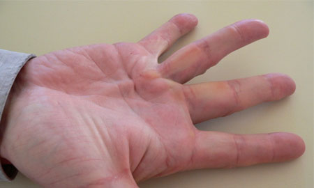  Деформация сустава пальца 