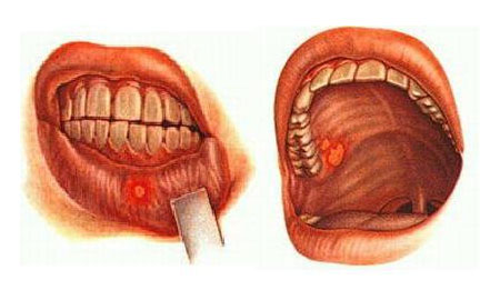 Заболевания полости рта у детей детские болезни thumbnail