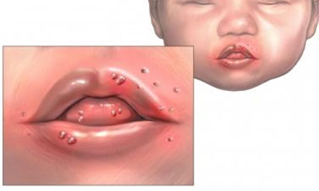 Болезни слизистой полости рта у детей thumbnail