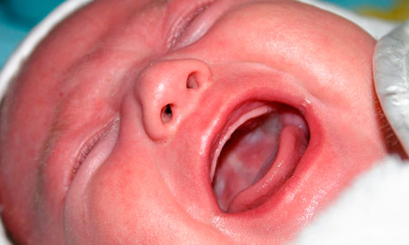 Лечение стоматита у ребенка комаровский thumbnail
