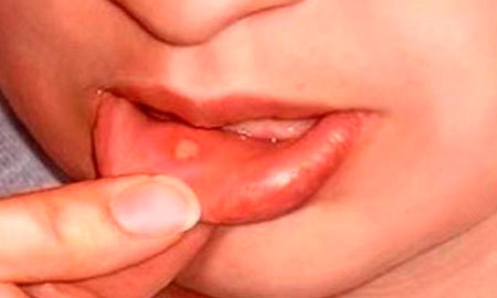 Стоматит лечение у детей доктор комаровский видео thumbnail