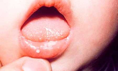Герпесный стоматит у ребенка лечение комаровский видео thumbnail