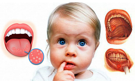 Болезни слизистой полости рта у детей