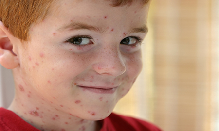 Болячки на коже лица у детей